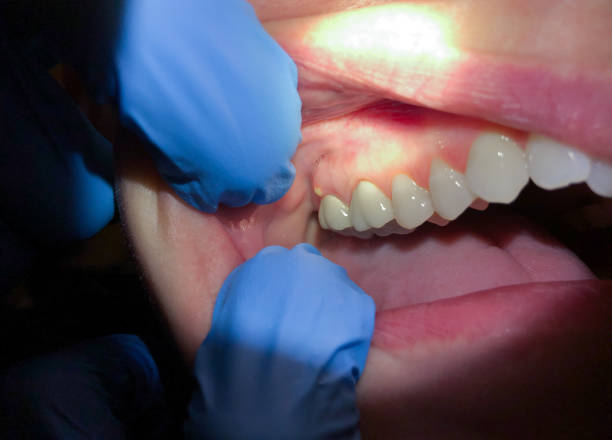 Best Emergency Broken Tooth Repair in Simpsonville, KY